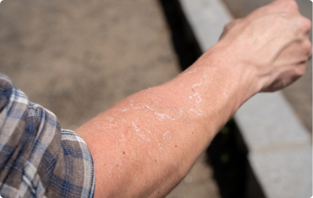 Õlina ärritunud ja kuivale nahale